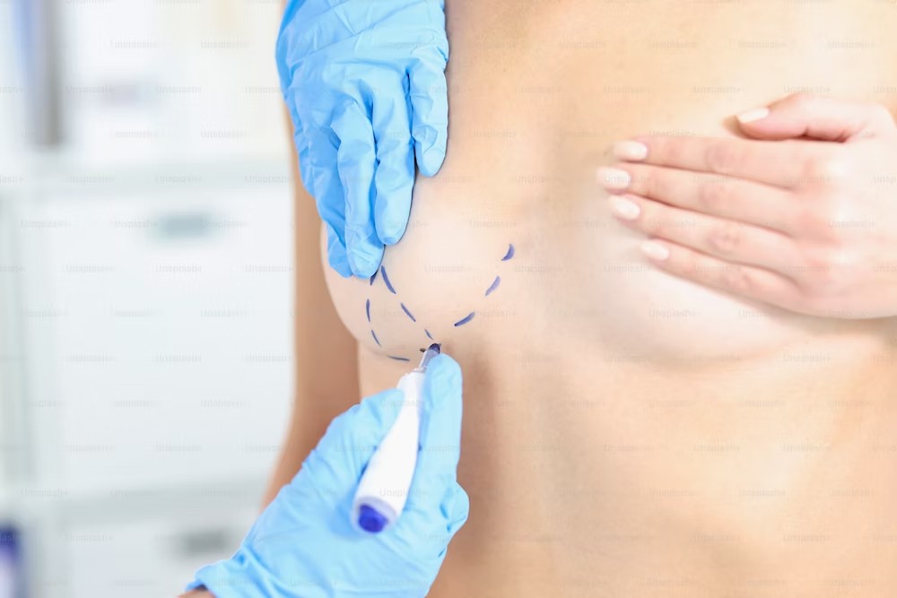 Mammaplasty breast reduction