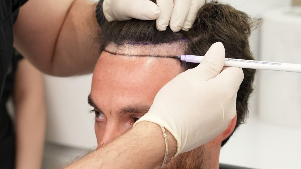 hair transplant